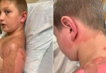 Nova vrsta izazova :Deca u bolnici sa strašnim opekotinama, jedna devojčica umrla