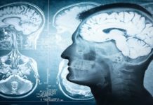 Novi lek za Alchajmerovu bolest: Vrata nade otvorena, ali uz oprez novi-lek-za-alchajmerovu-bolest:-vrata-nade-otvorena,-ali-uz-oprez