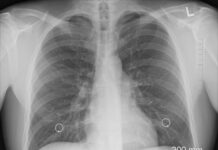 Sve o tuberkulozi koja se pojavila u Novom Pazaru među decom: Odakle bolest i kako teče lečenje? sve-o-tuberkulozi-koja-se-pojavila-u-novom-pazaru-medju-decom:-odakle-bolest-i-kako-tece-lecenje?