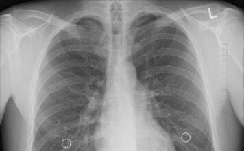 Sve o tuberkulozi koja se pojavila u Novom Pazaru među decom: Odakle bolest i kako teče lečenje? sve-o-tuberkulozi-koja-se-pojavila-u-novom-pazaru-medju-decom:-odakle-bolest-i-kako-tece-lecenje?