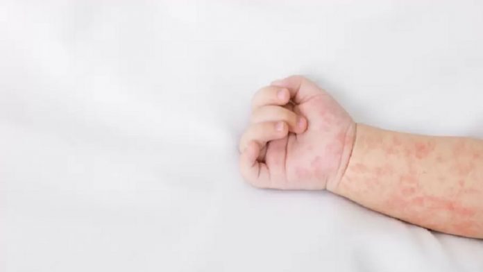 broj-obolelih-od-morbilau-novom-pazaru-raste broj-obolelih-od-morbilau-novom-pazaru-raste