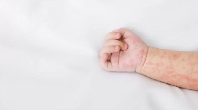 novi-pazar-bukti-od-morbila